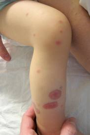геморрагический васкулит у ребенка