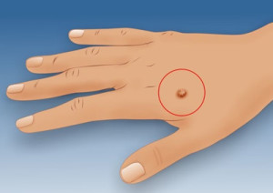 670px-Get-Rid-of-Warts-Step-37Bullet1-Version-2